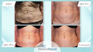 Mostly Asked Questions About Venus Freeze 3