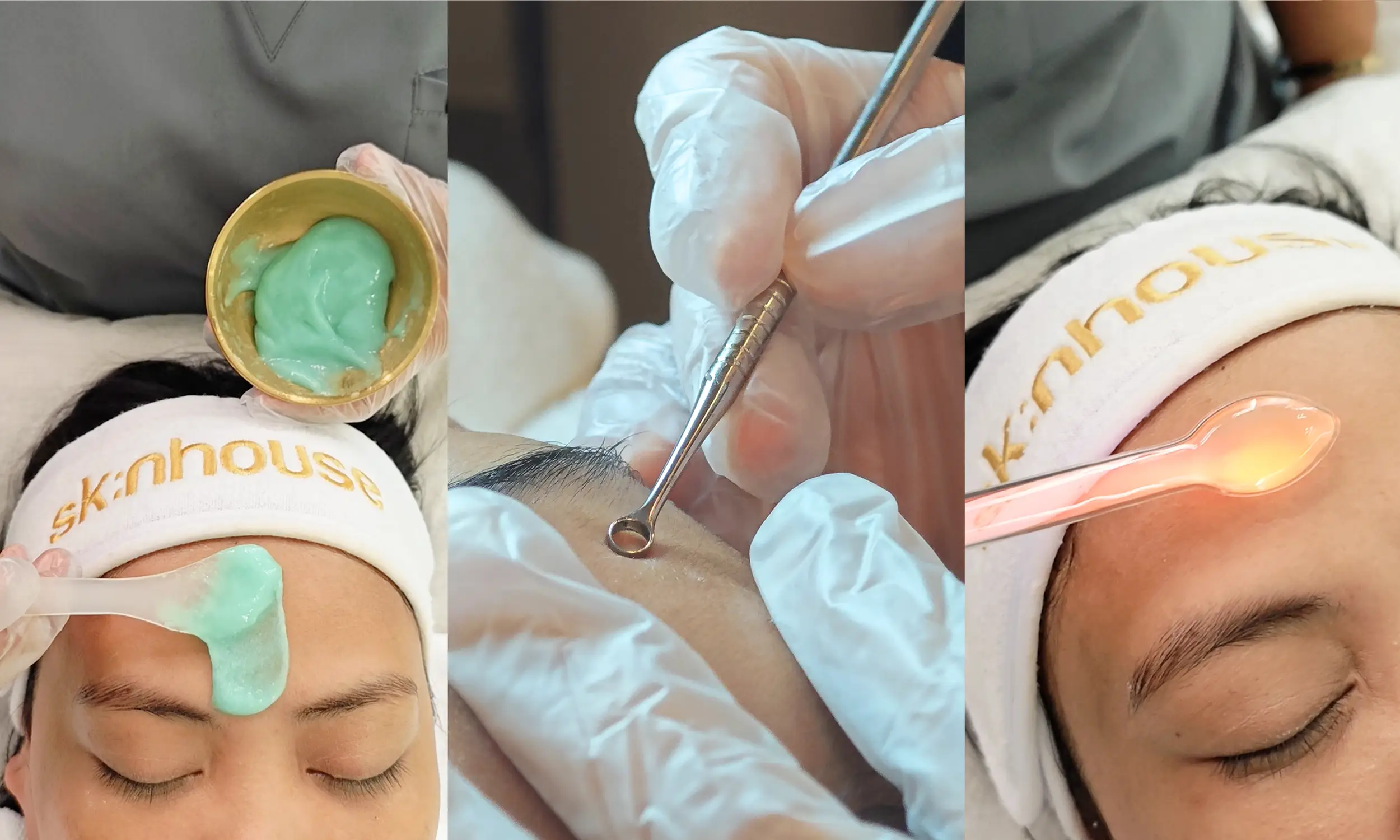 Advance Acne Facial