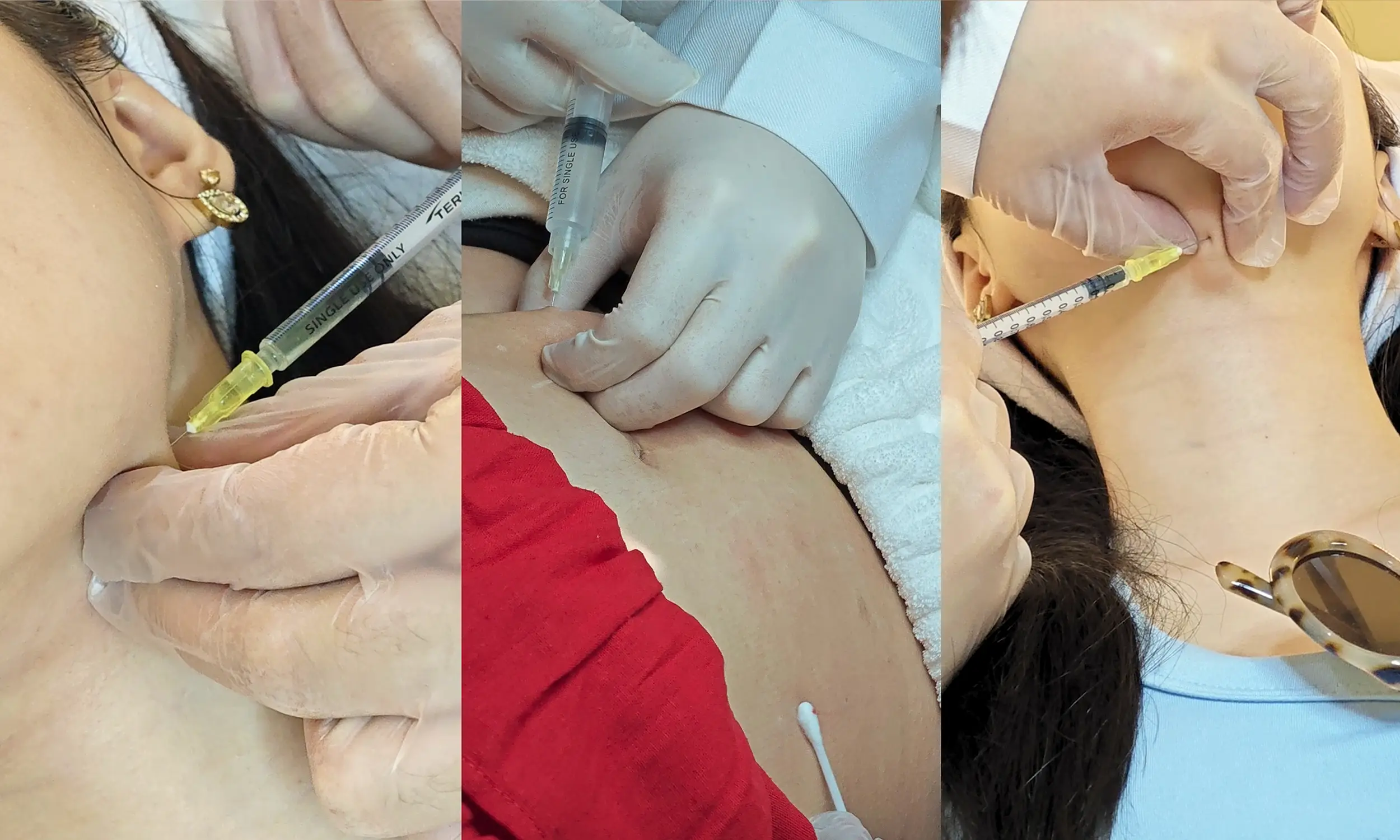 Mesotherapy