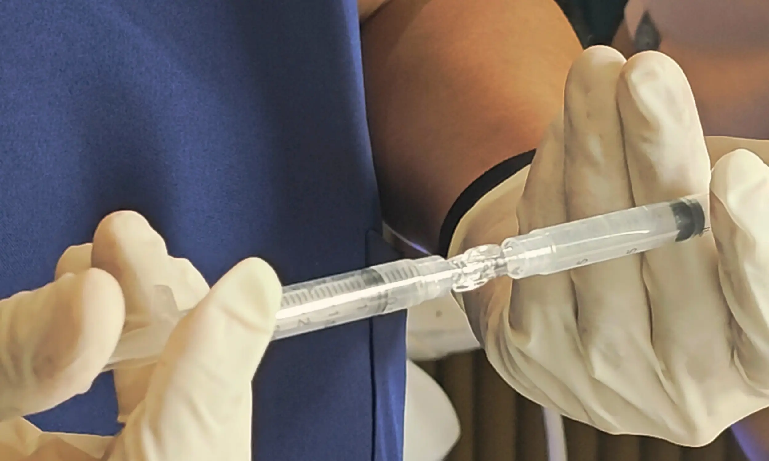 Microneedling with ASCE Exosomes
