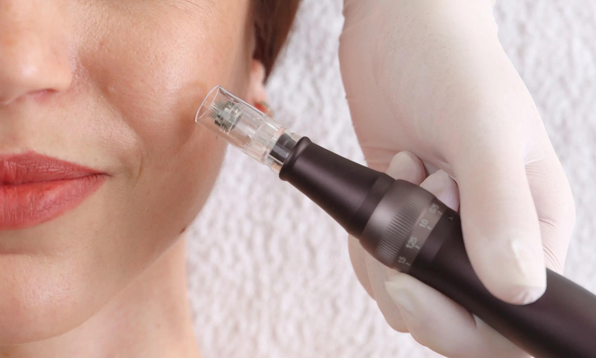 Microneedling