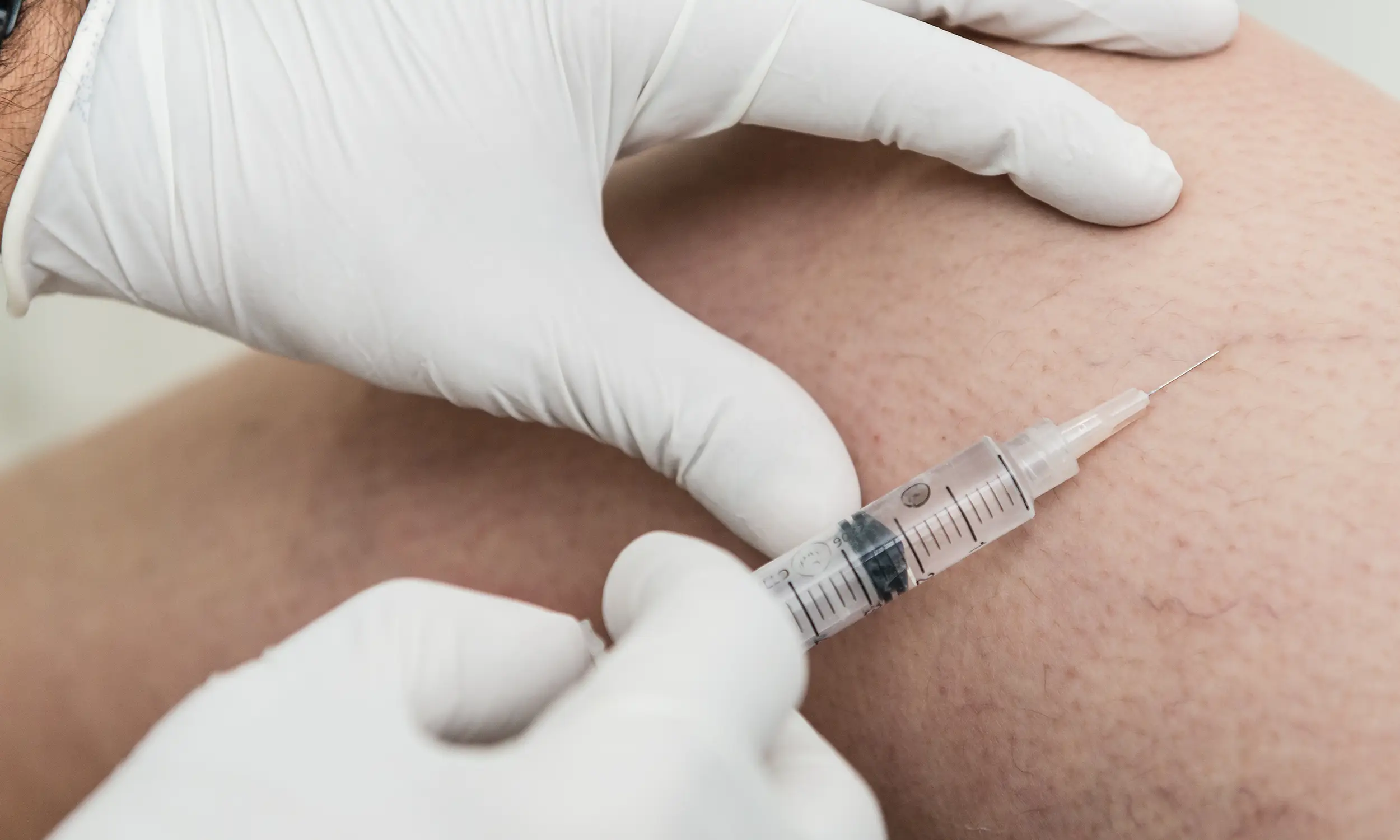 Sclerotherapy