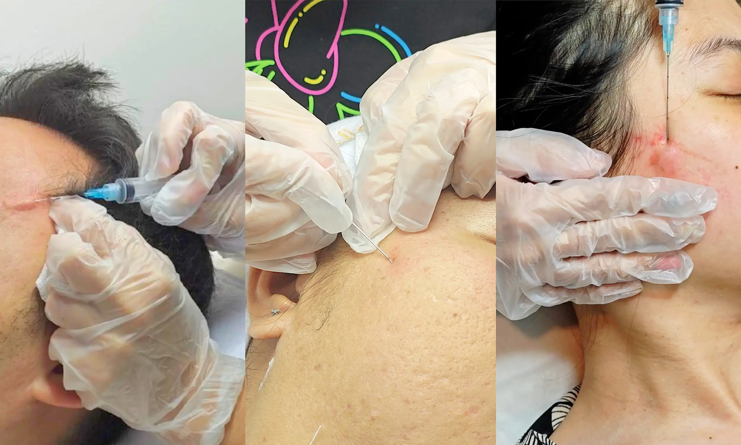 Subcision