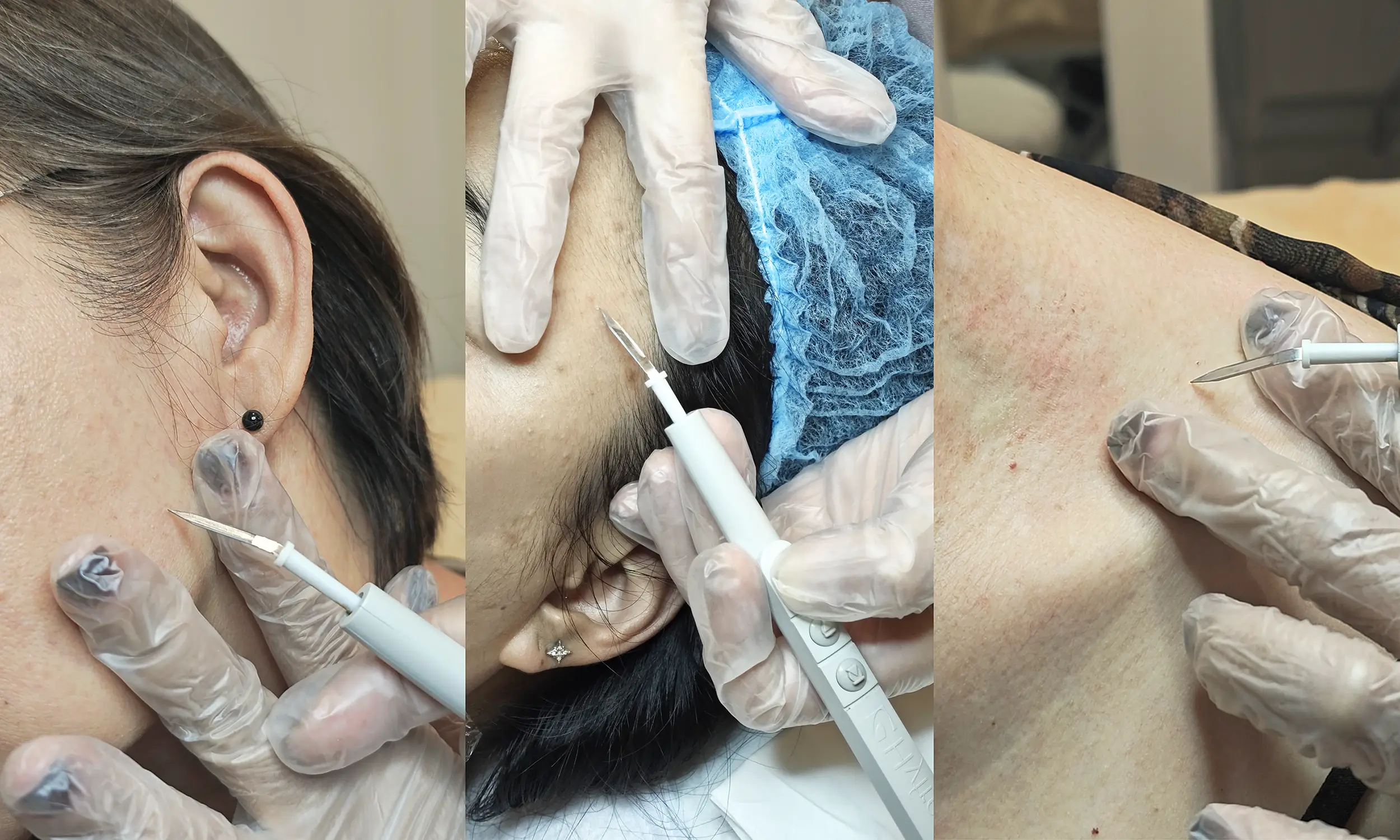 Warts Removal