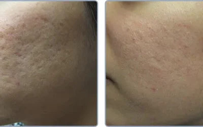 Deep acne scar treatment clinical results Skin House