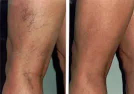 GentleYag® Laser Vein Removal