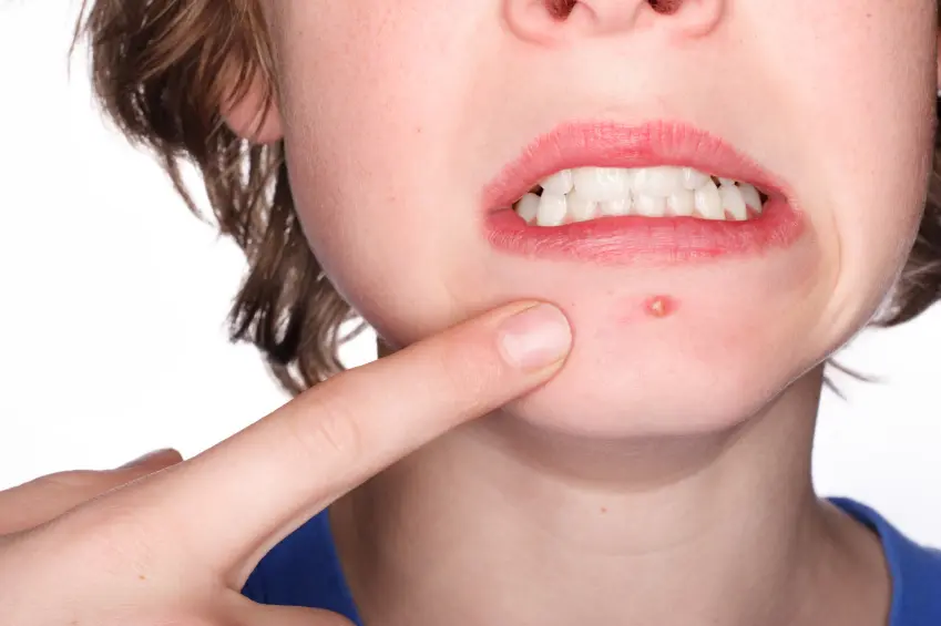 8 things you should avoid if you have acne prone skin.